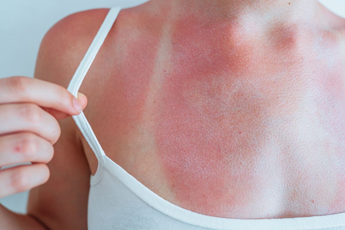 Sonnenbrand im Enzkreis: Vermeiden, richtig behandeln, ernst